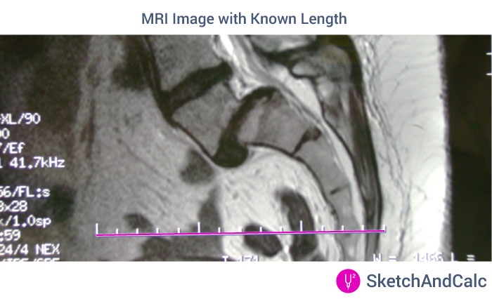 MRI image with scale marker that can be used to calibrate SketchAndCalc to find the area of irregular shapes.