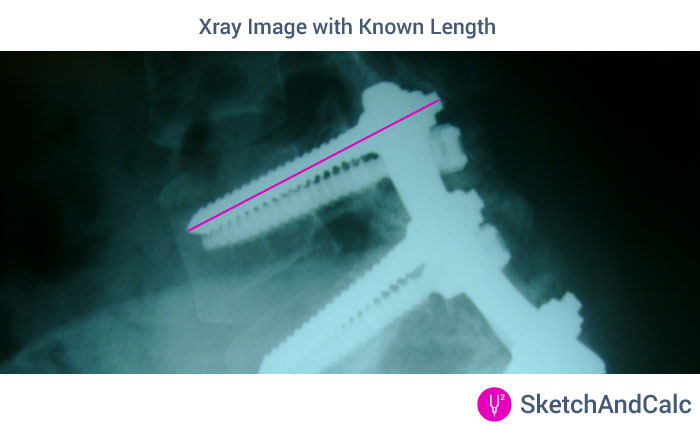 Xray image with hardware that can be used to calibrate the drawing scale when calculating the irregular area.